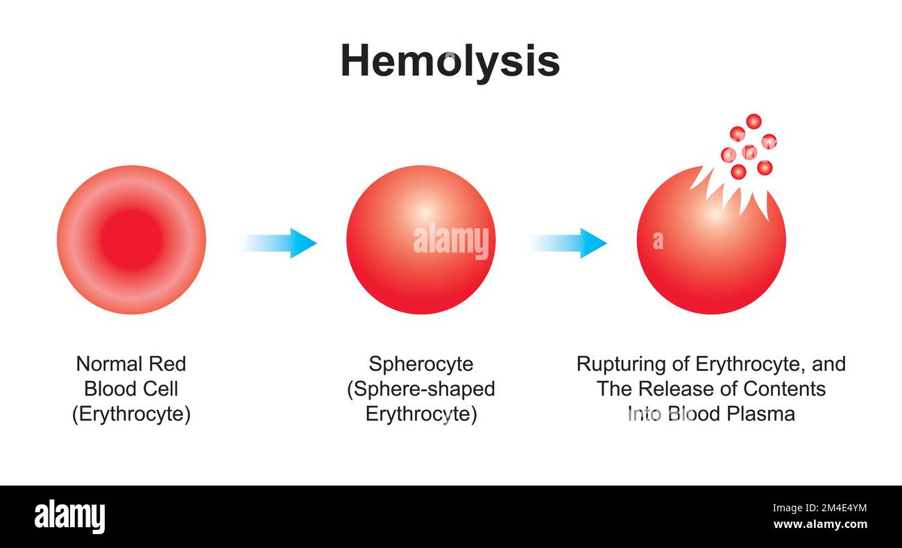 Progettazione scientifica dell'emolisi. La distruzione dei globuli rossi. Simboli colorati. Illustrazione vettoriale. Illustrazione Vettoriale