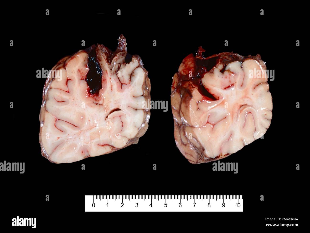 Campione lordo che mostra due sezioni cerebrali del lobo frontale che mostra un'emorragia intraparenchimale. L'ipertensione è la causa più frequente di questa t Foto Stock