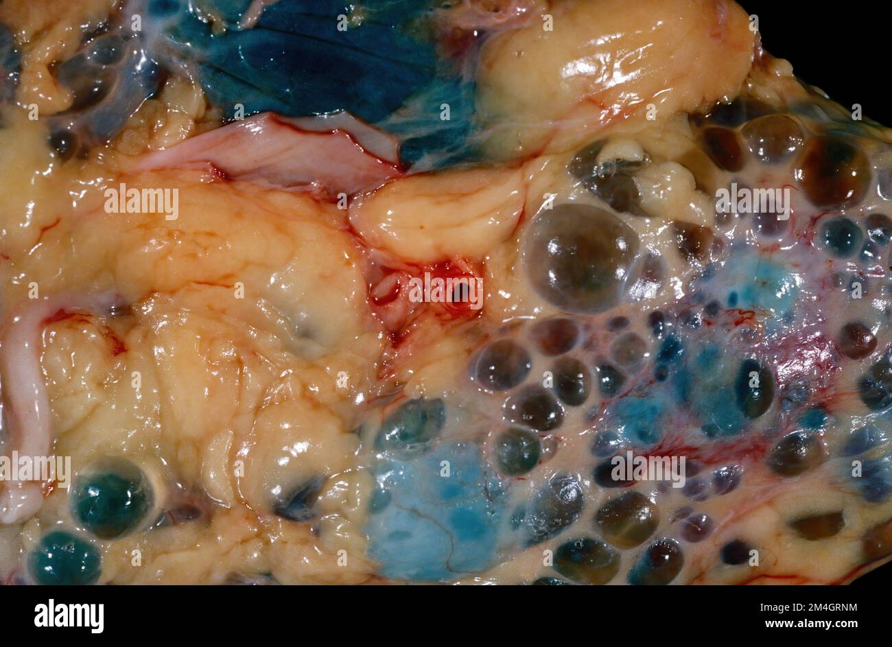 Primo piano di un campione grossolano che mostra la superficie di un rene  umano in un caso di malattia autosomica dominante del rene policistico  (ADPKD). La superficie è f Foto stock -