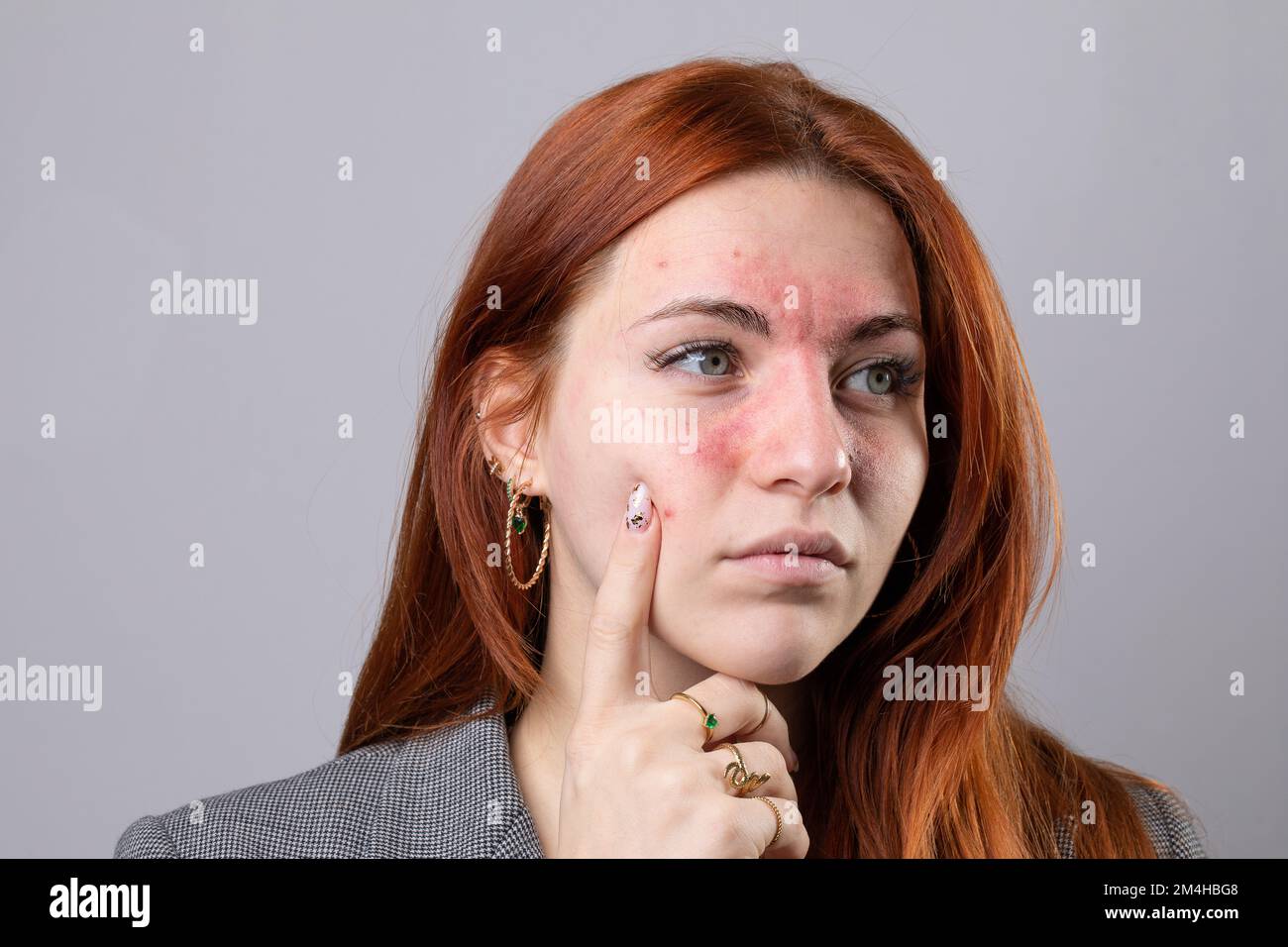 Giovane ragazza caucasica skinned equa che soffre di acne rosacea sulla pelle del viso. Sintomi di couperose con arrossamento delle guance e del naso Foto Stock