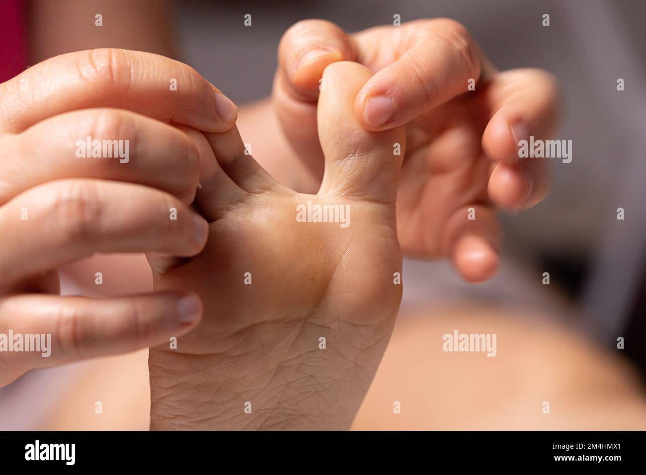 Primo piano delle mani di un infermiere che ispeziona il piede di un paziente con il piede dell'atleta. Infezione fungina tra le dita dei piedi che causa prurito, fallo odo Foto Stock