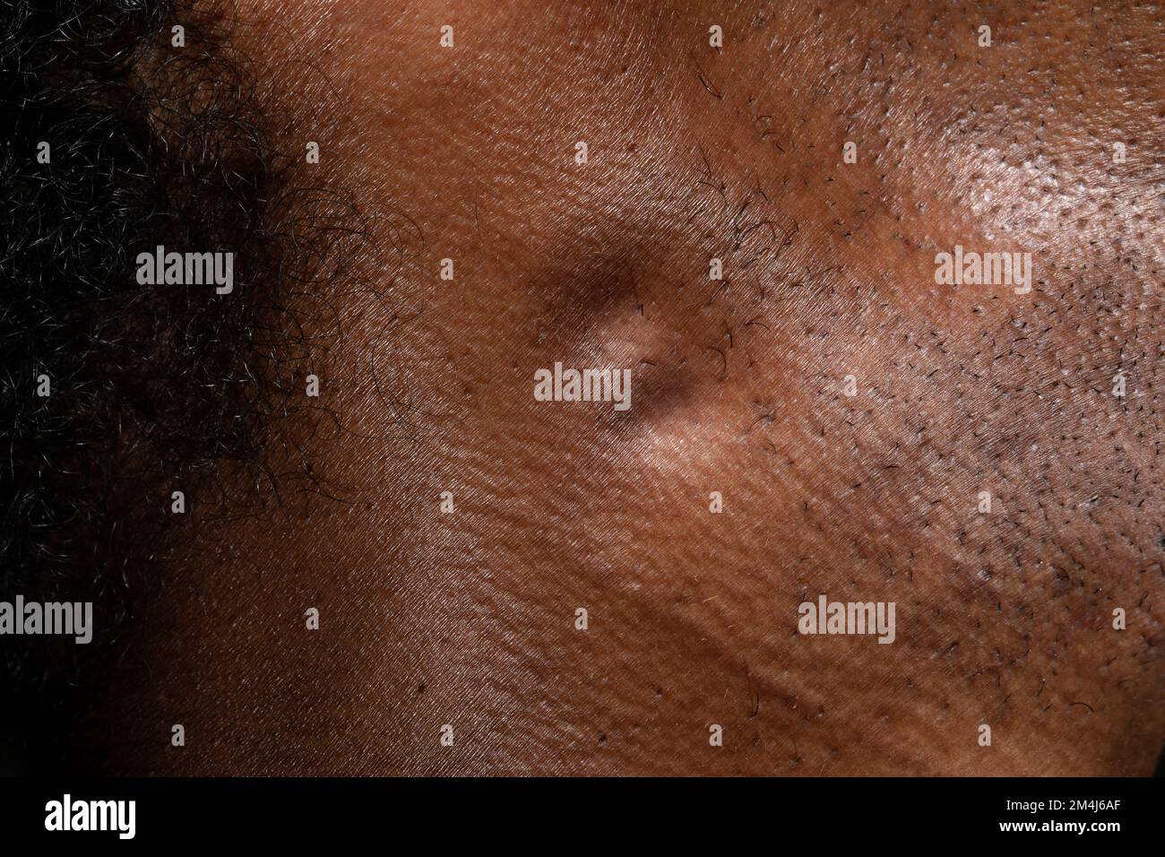 Macro dei linfonodi gonfi nel collo di un uomo africano, risposta immunitaria del sistema linfatico o possibilità di neoplasia maligna Foto Stock