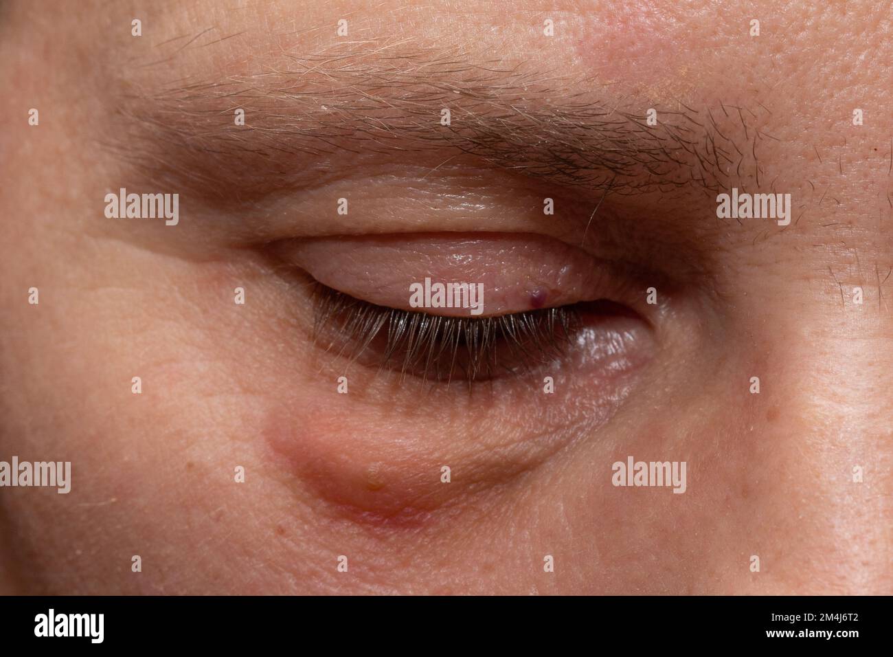 Infiammazione o gonfiore della borsa sotto gli occhi immagini e fotografie  stock ad alta risoluzione - Alamy