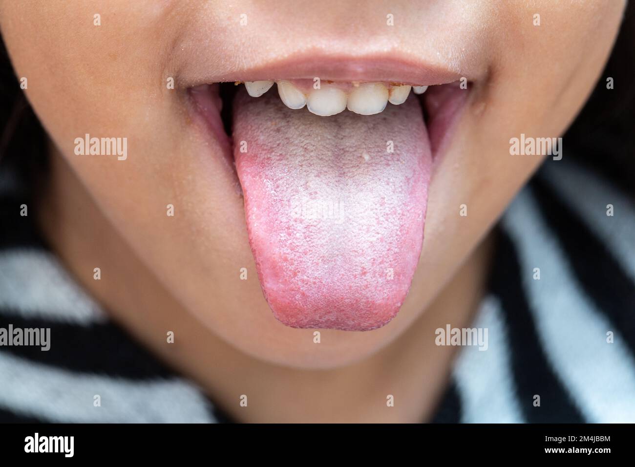 Primo piano della lingua di una bambina con patina batterica a causa della scarsa igiene orale o della scarsa nutrizione. Foto Stock