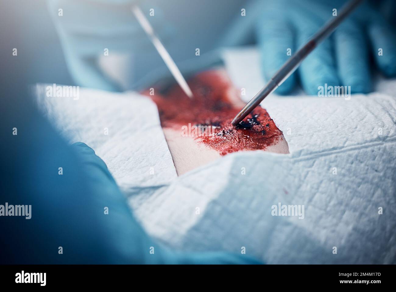 Medici, infermieri o chirurgia mani su paziente tagliato in pronto soccorso ospedale per ulcera allo stomaco, attacco di cuore o scoppio appendice. Sangue, sanità Foto Stock