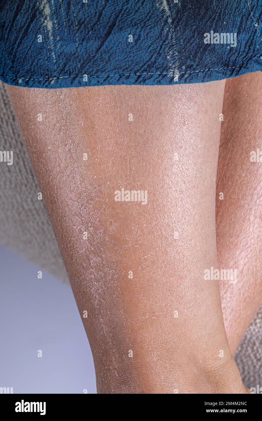 Le gambe della donna si staccano a causa della pelle eccessivamente secca e disidratata. Mancanza di idratazione dopo essere al sole. Danni causati dai raggi UV. Foto Stock