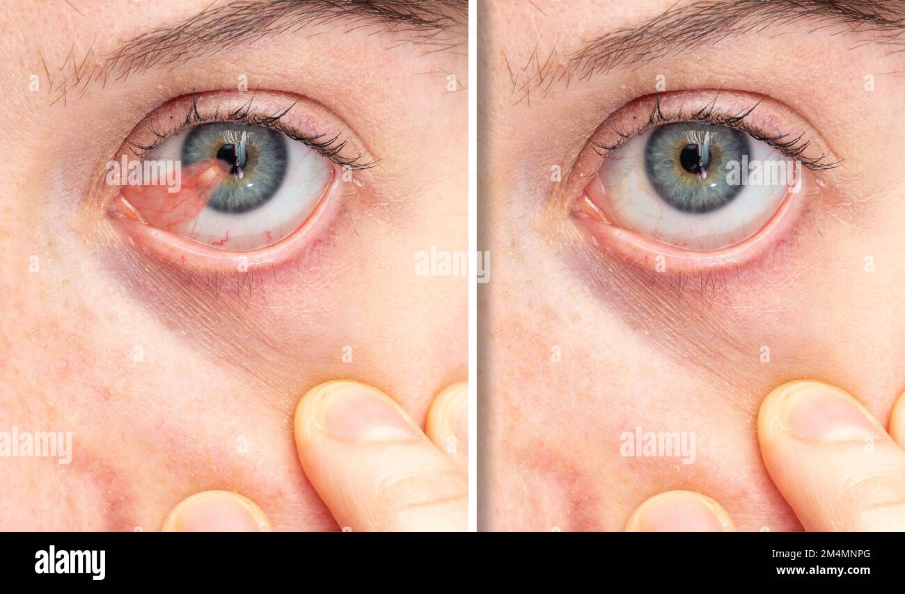 Macro di un occhio blu di una ragazza affetta da pterygium prima e dopo la rimozione chirurgica, una membrana triangolare alare che si verifica negli occhi che rosso Foto Stock