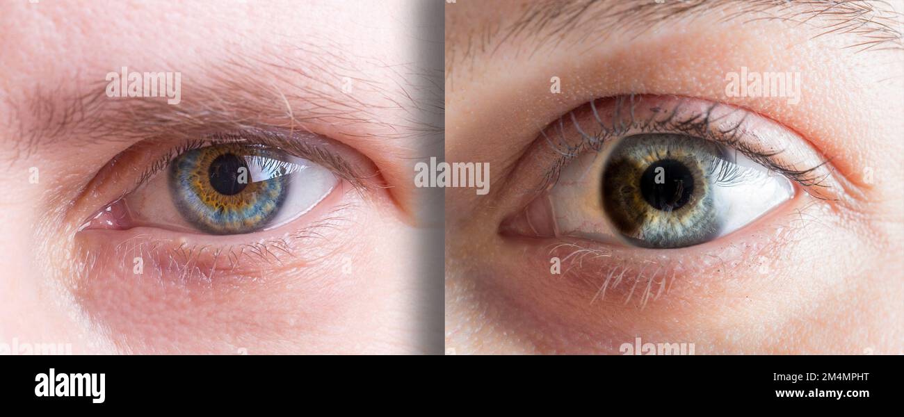 due diversi casi di eterocromia dell'occhio di due donne. Macro di colore blu e marrone occhio iride. Foto Stock