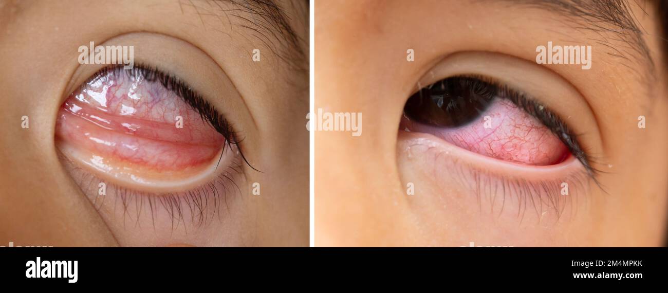 Macro di un occhio molto rosso con caratteristiche orientali dovute alla congiuntivite. Secchezza e arrossamento della sclera a causa di irritazione. Collage a doppia immagine per co Foto Stock