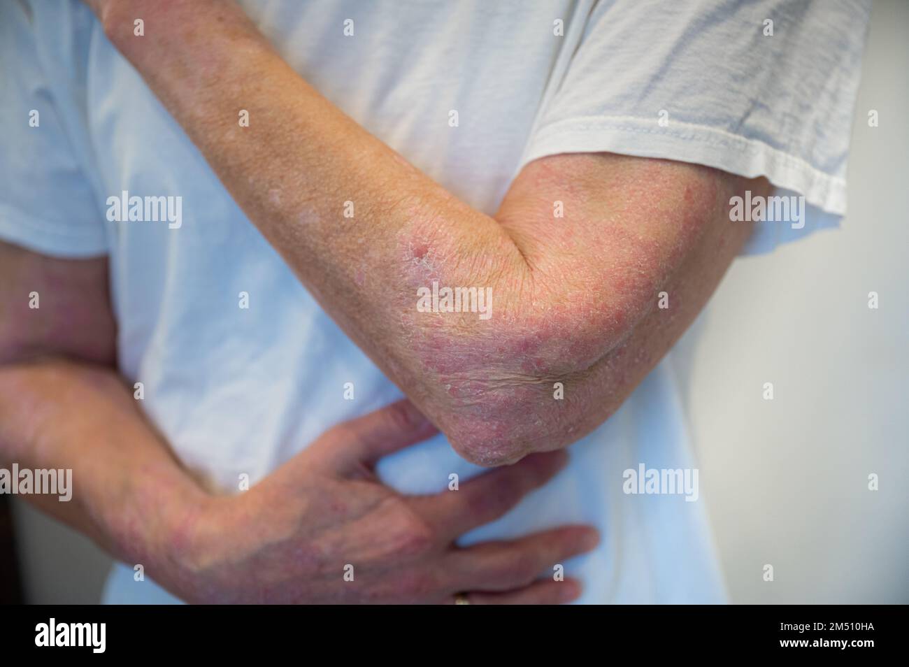 Malattia della pelle psoriasi su braccio e mano Foto Stock