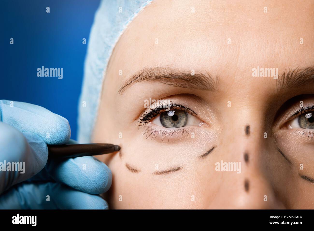 chirurgo che prepara il viso della donna per la chirurgia plastica. procedura di rifacimento Foto Stock
