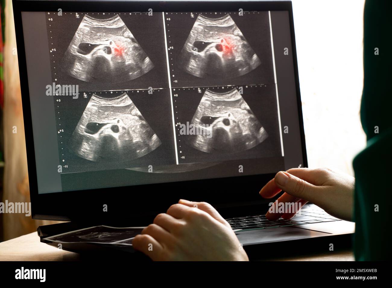 Ecografia dell'addome di una donna su uno schermo monitor portatile in un ufficio medico, diagnostica di un dolore addominale, medicina Foto Stock