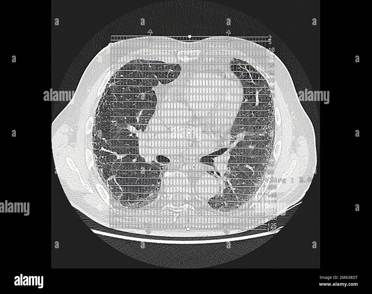 Tomografia dei polmoni affetti da polmonite interstiziale. La tomografia computerizzata (TC) è una tecnica di imaging medicale che utilizza i raggi X per creare Foto Stock