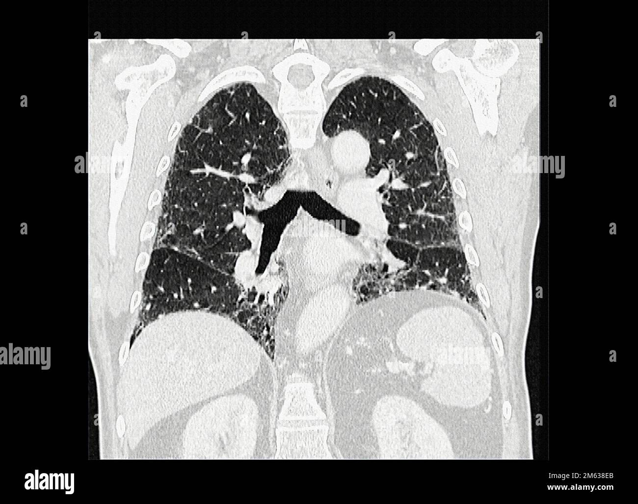Tomografia dei polmoni affetti da polmonite interstiziale. La tomografia computerizzata (TC) è una tecnica di imaging medicale che utilizza i raggi X per creare Foto Stock
