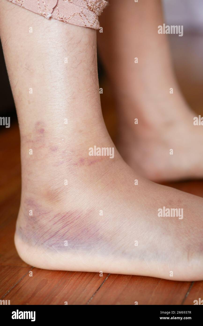 primo piano dei piedi delle donne con gonfiore Foto Stock