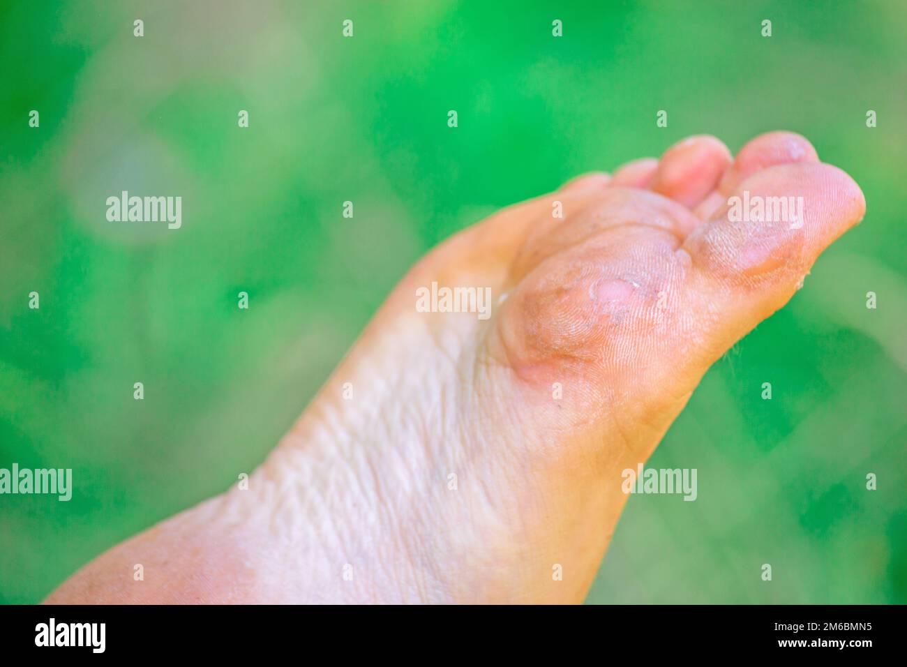Pelle secca disidratata sui talloni dei piedi femminili con calli Foto Stock