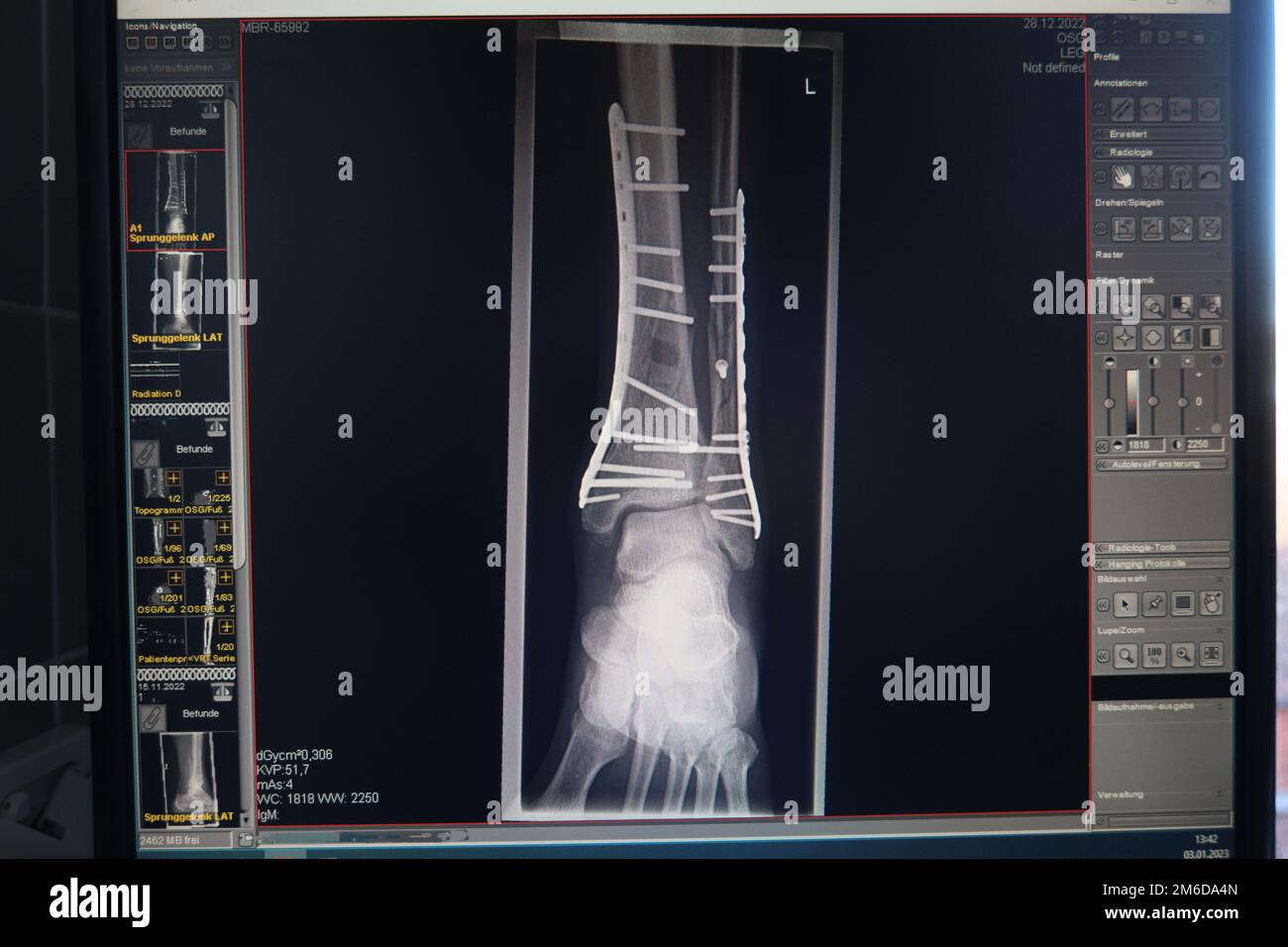 Una radiografia mostra una frattura dell'articolazione della caviglia, che è stata trattata con piastre e viti Foto Stock