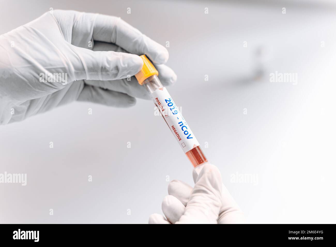 Risultato positivo del test del sangue per il nuovo Coronavirus che si sta diffondendo rapidamente. Foto Stock