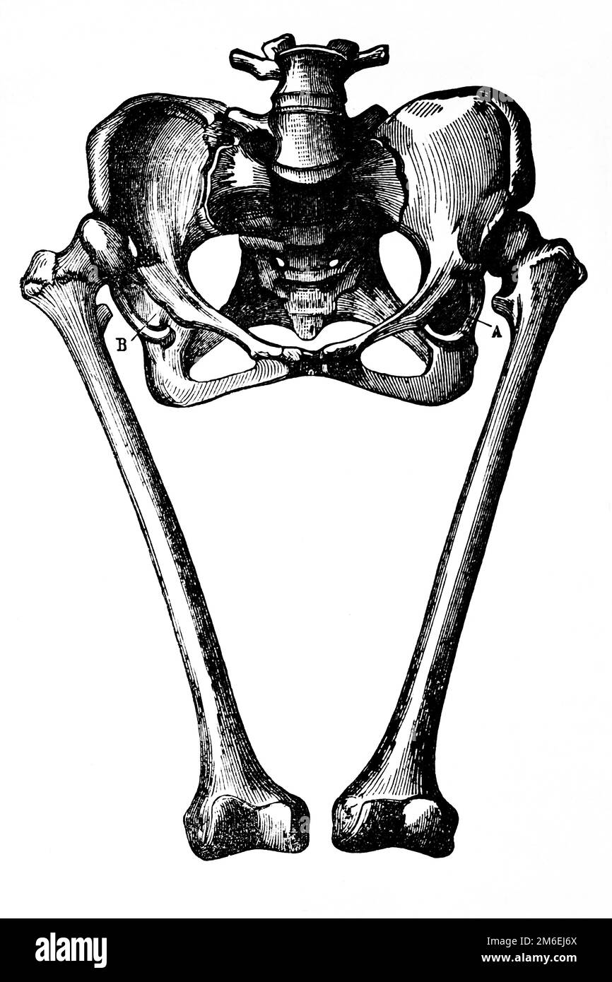 Doppia dislocazione congenita del femore. Antica illustrazione da un libro medico. 1889. Foto Stock