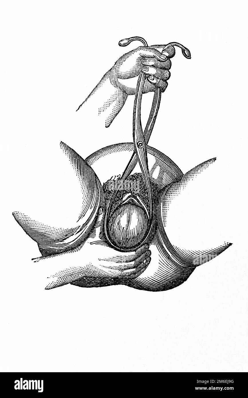 Aiutare la nascita. La mano destra sostiene il perineo aiutando la deflessione della testa. Antica illustrazione da un libro medico. 1889. Foto Stock