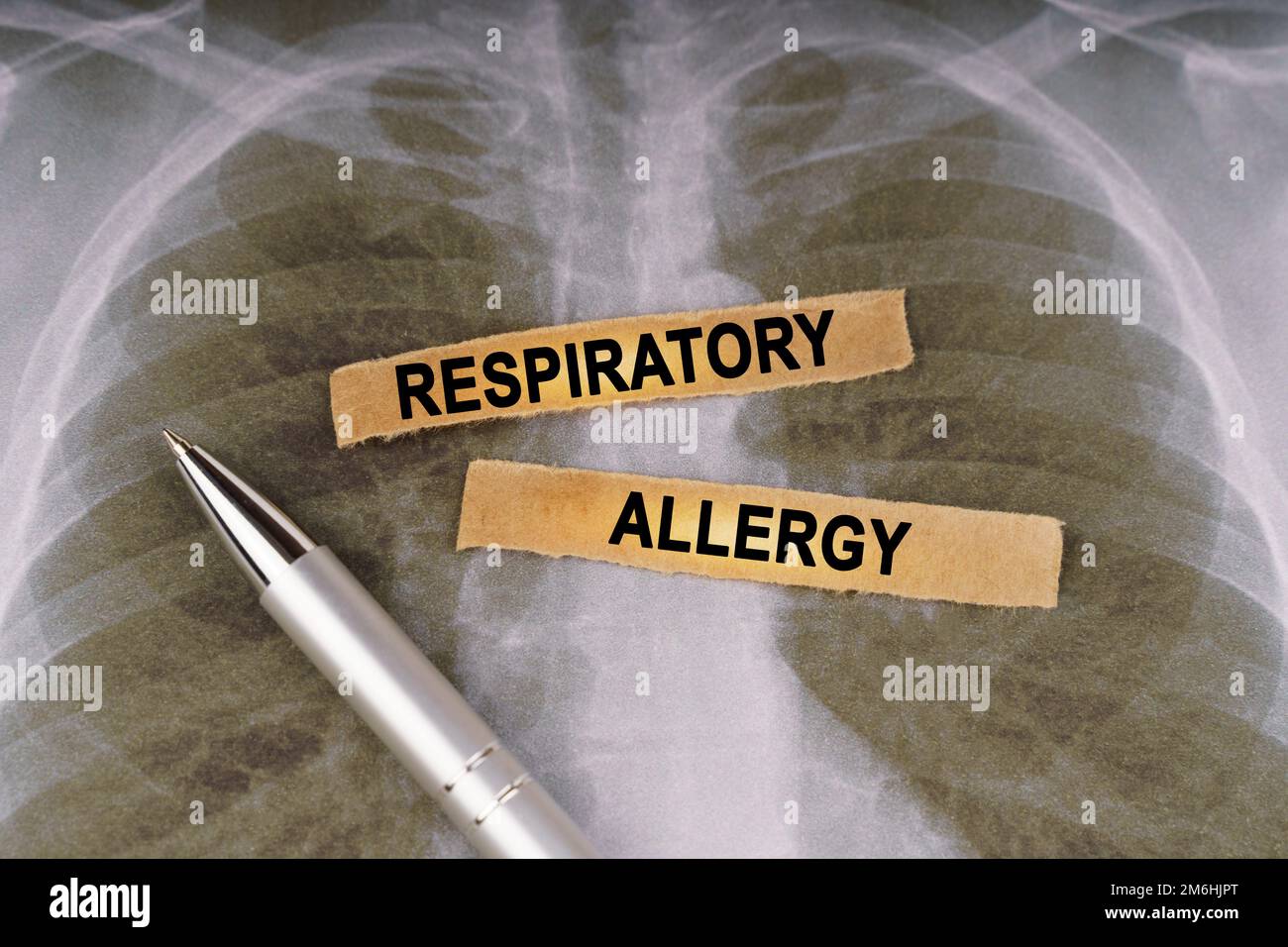 Concetto medico. Su una radiografia toracica umana, una penna e strisce di carta etichettate - allergia respiratoria Foto Stock