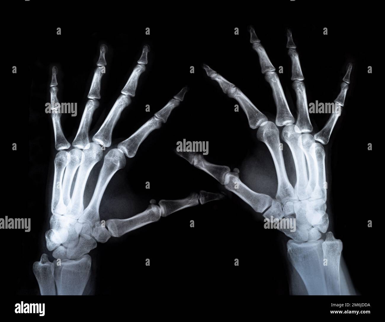 Radiografia a due mani con le dita scansione reale Foto Stock