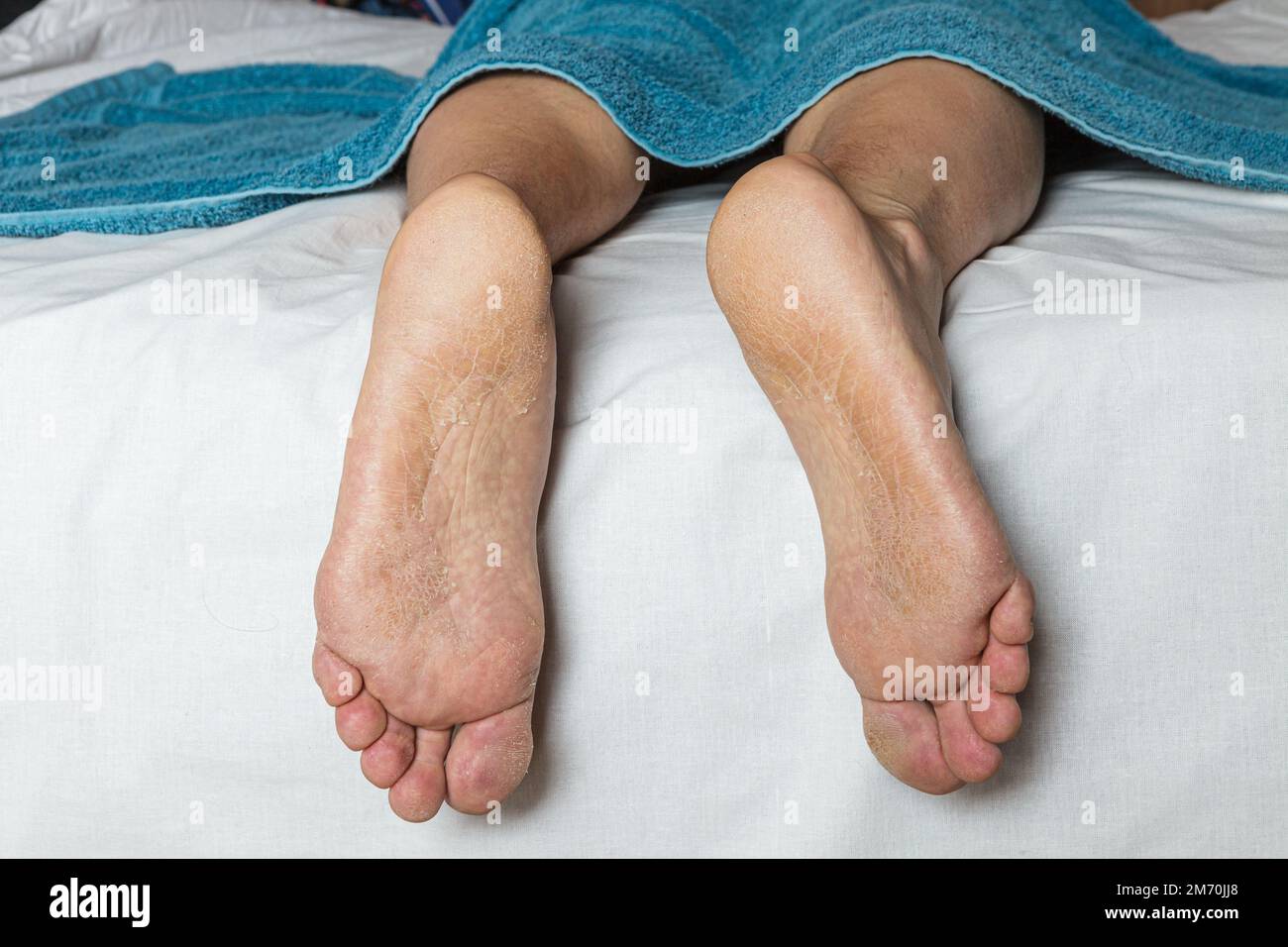 Pelle danneggiata sui piedi Foto Stock