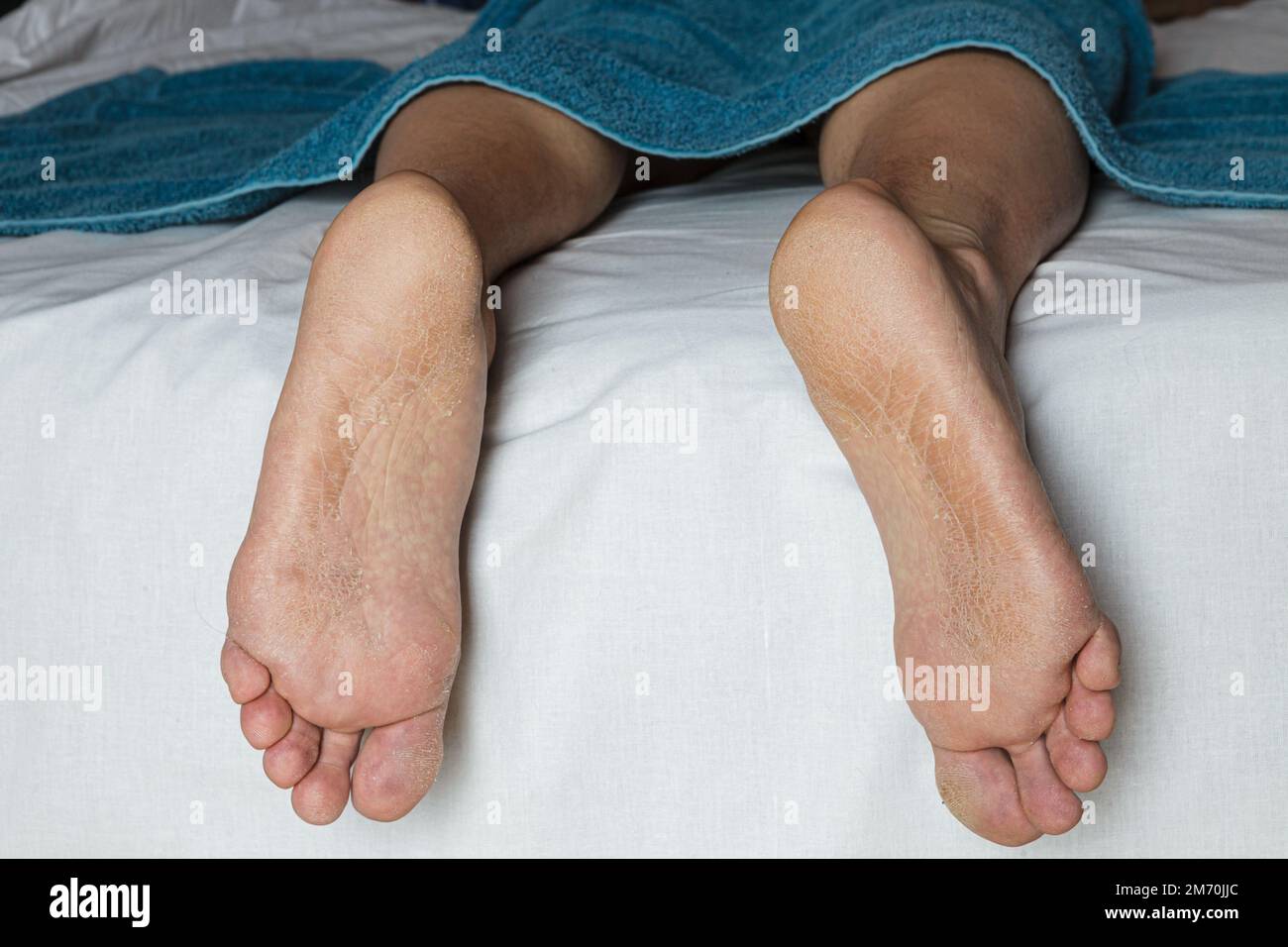 Pelle danneggiata sui piedi Foto Stock