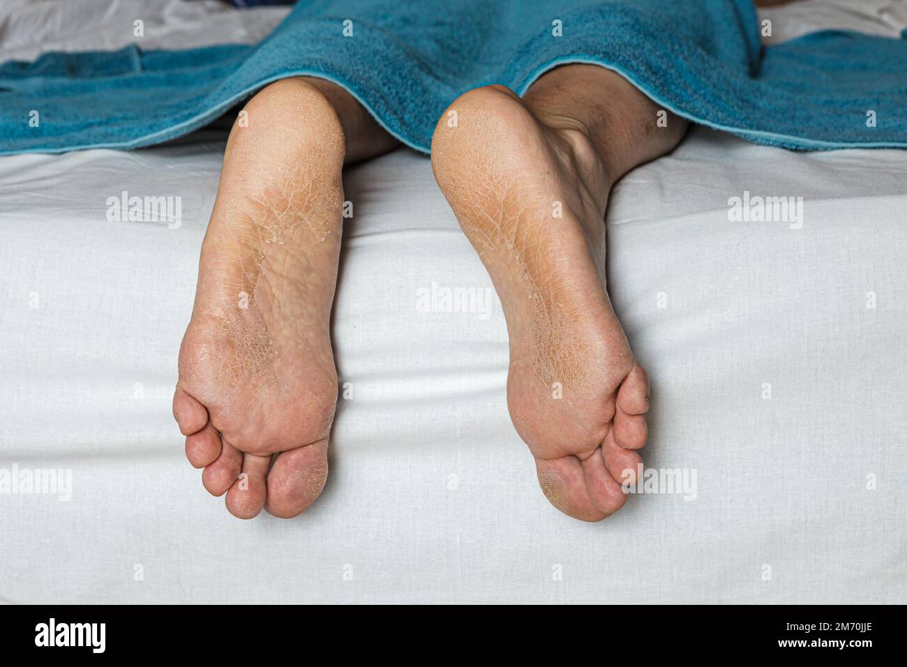 Pelle danneggiata sui piedi Foto Stock