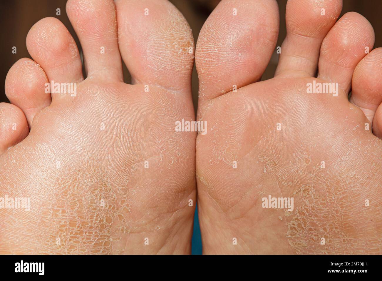 Pelle danneggiata sui piedi Foto Stock