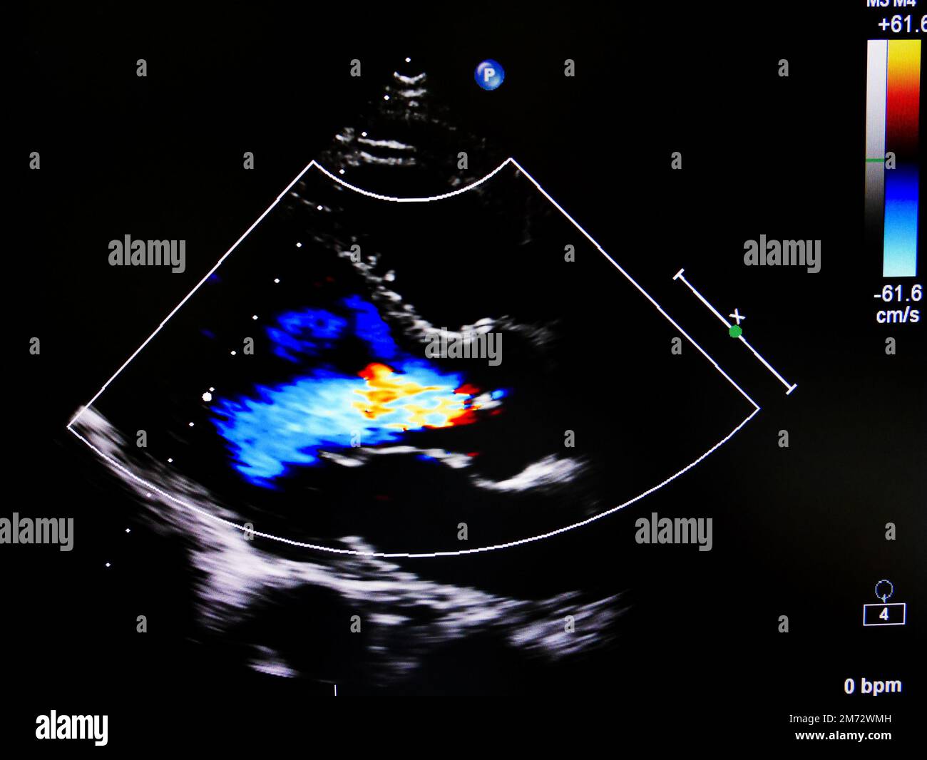 Colore flusso in modalità ecocardiogramma nella valvola mitrale rigurgito paziente Foto Stock