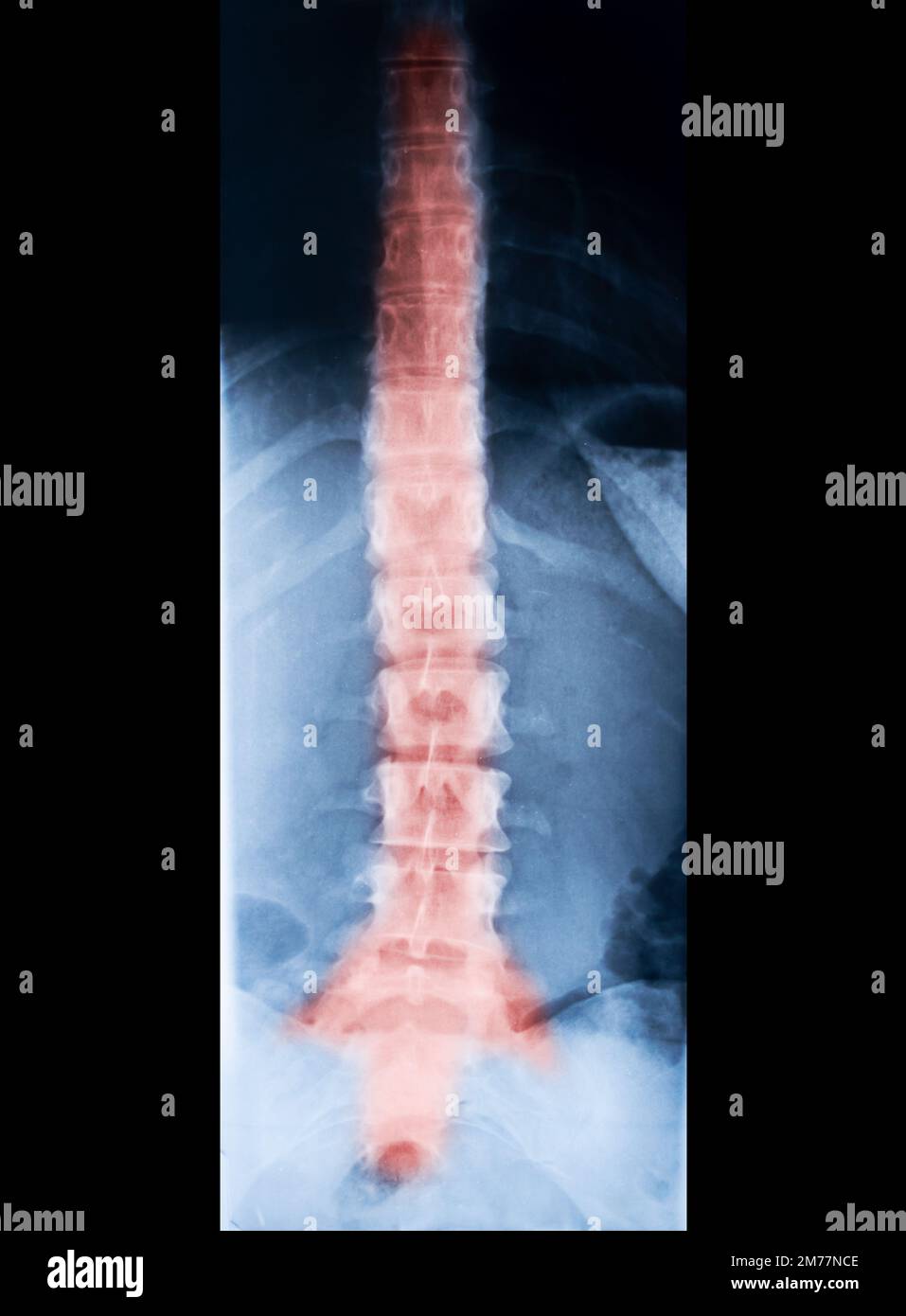 raggi x dello scheletro della colonna vertebrale. Dolore rosso sulle ossa Foto Stock