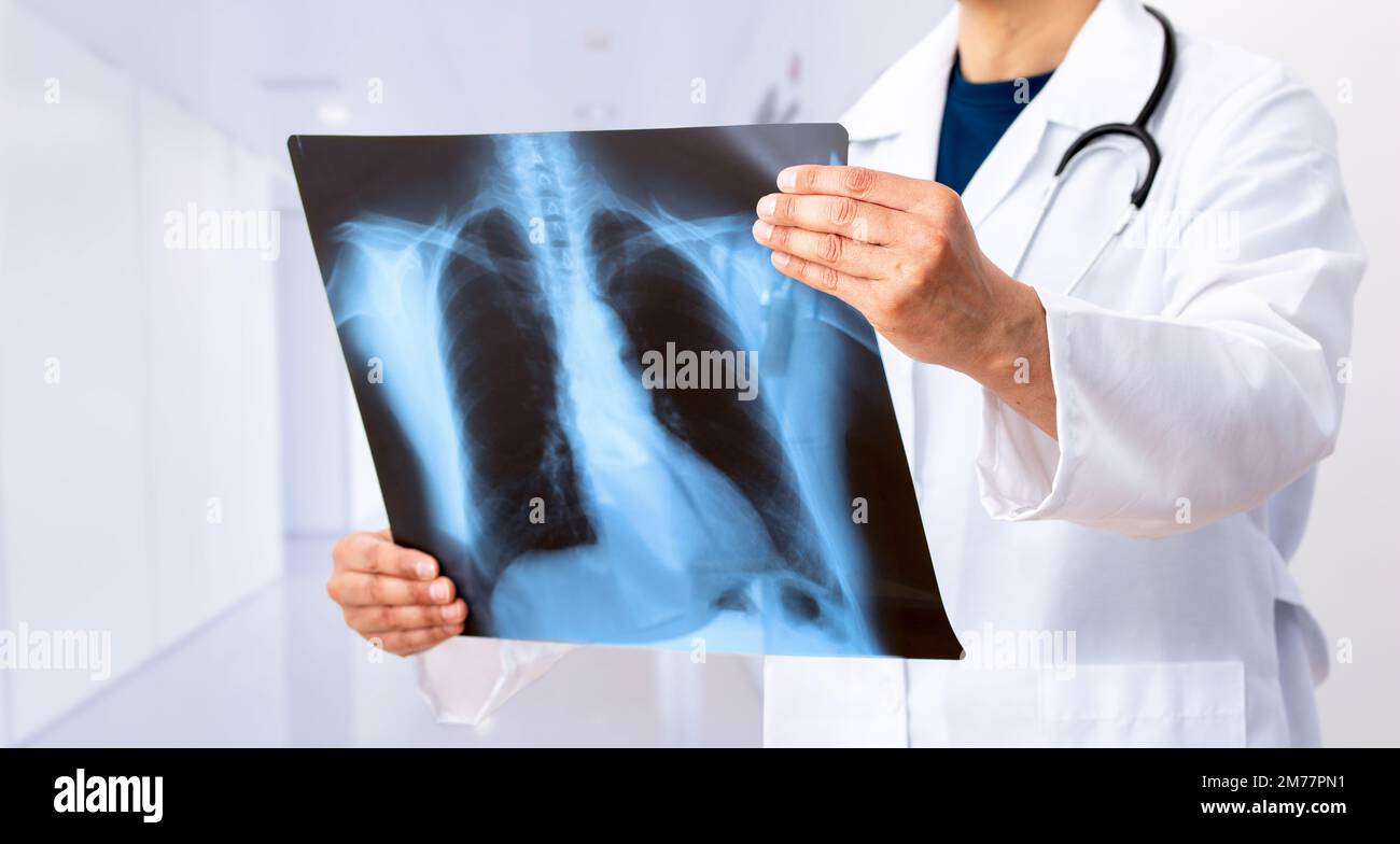 Cancro polmonare o polmonite. Controllo medico su immagine radiografica hanno problema tumore polmonare del paziente o lungo 19 Foto Stock