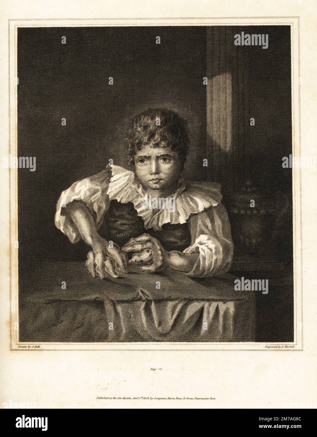 Ragazzo di Westmoreland con tumori ossei nelle mani e nei polsi, 1795. Bell e Alex Munro raccomandano l'amputazione o il trattamento del mercurio, del laudanum e della Confectio-Japonica (elettuario composto del catechu). Incisione su copperplate di Edward Mitchell dopo un'illustrazione di John Bell dai suoi propri principi di Chirurgia, come si riferiscono a ferite, ulcere e fistole, Longman, Hurst, Rees, Orme and Brown, Londra, 1815. Foto Stock