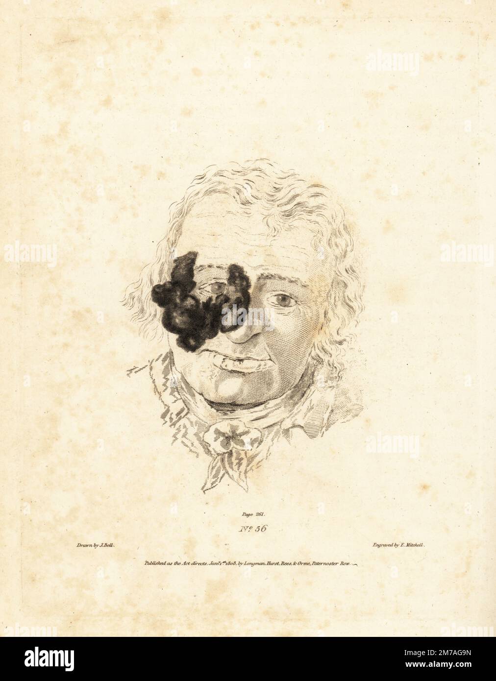 Grande tumore canceroso sulla guancia di un vecchio operaio agricolo. Cresciuto ad un'altezza di due pollici (5cm) sopra la pelle ed emorragia spesso. Incisione su copperplate di Edward Mitchell dopo un'illustrazione di John Bell dai suoi propri principi di Chirurgia, come si riferiscono a ferite, ulcere e fistole, Longman, Hurst, Rees, Orme and Brown, Londra, 1815. Foto Stock