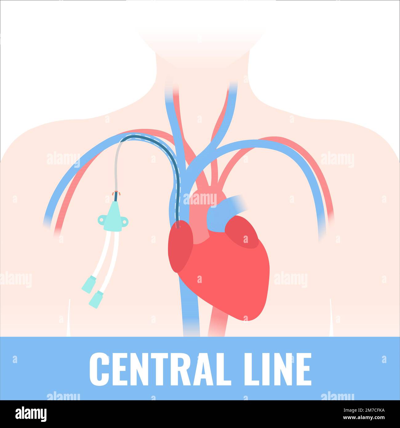 Diagramma medico del catetere venoso della linea centrale con tunnel Illustrazione Vettoriale