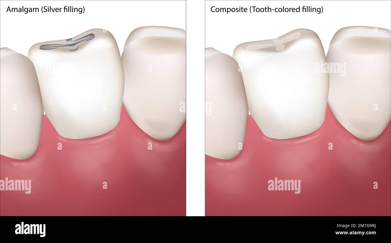 Strumenti Odontoiatrici Per Riempimento Composito - 4 Pezzi Sonda E Spatola Doppia Estremità Strumenti Otturazione Denti - Foto 11