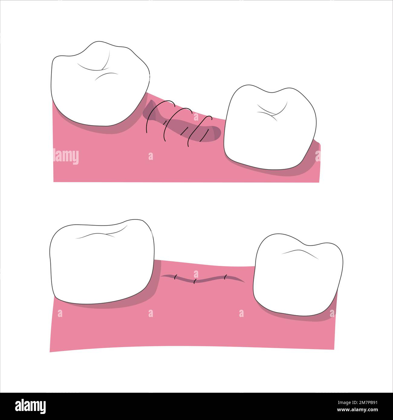 Illustrazione medica del processo di estrazione dei denti malsano. Guarigione della ferita. Illustrazione Vettoriale