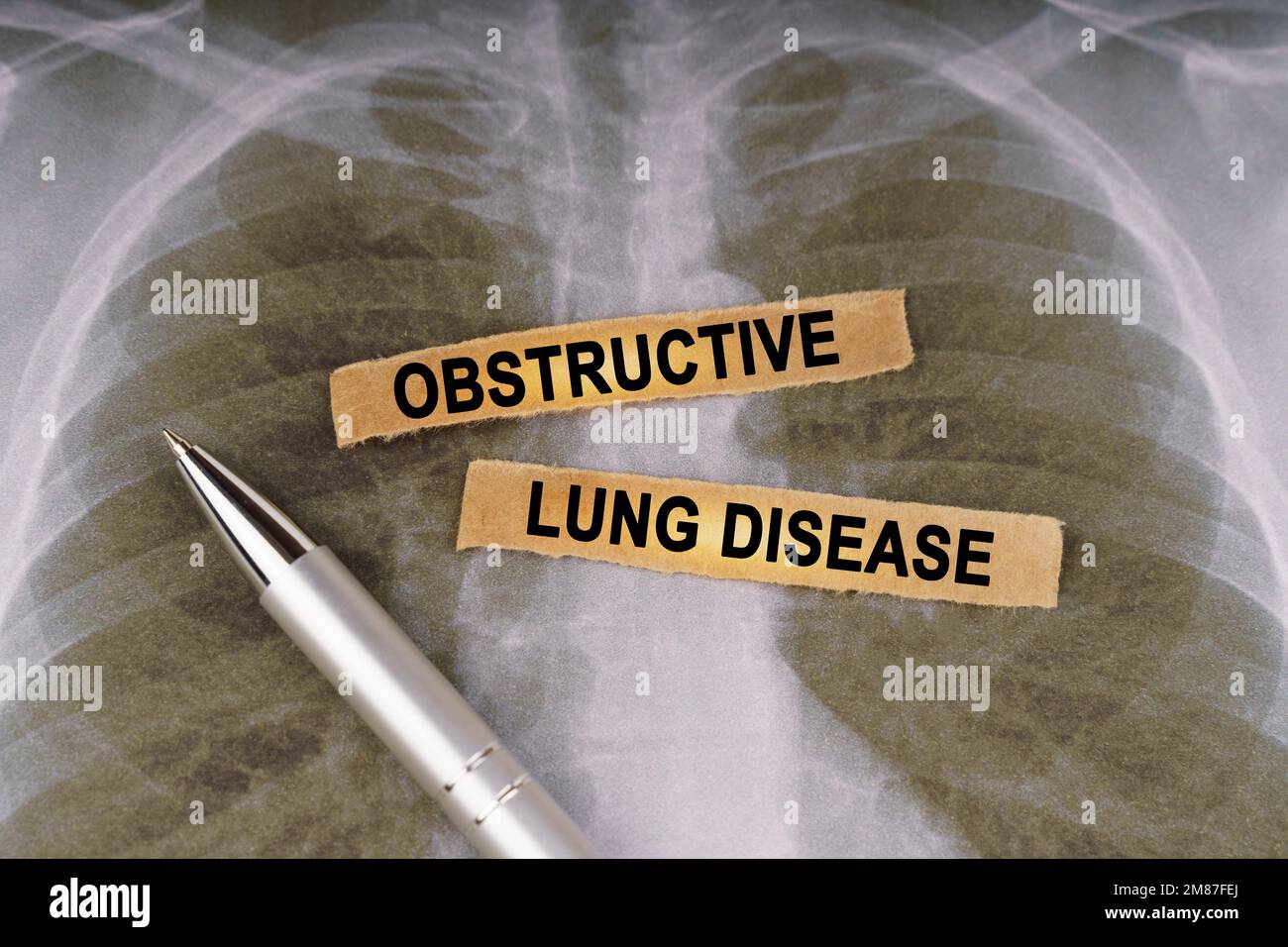 Concetto medico. Su una radiografia del torace umano, una penna e strisce di carta etichettate - malattia polmonare ostruttiva Foto Stock