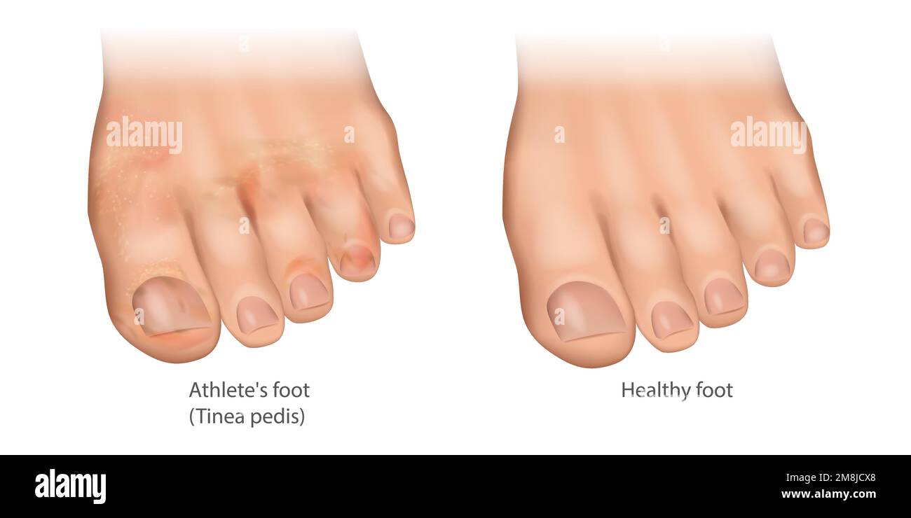 Illustrazione del piede dell'atleta e del piede sano. Tinea pedis o ringworm del piede, mocassino piede. Infezione cutanea dei piedi Illustrazione Vettoriale