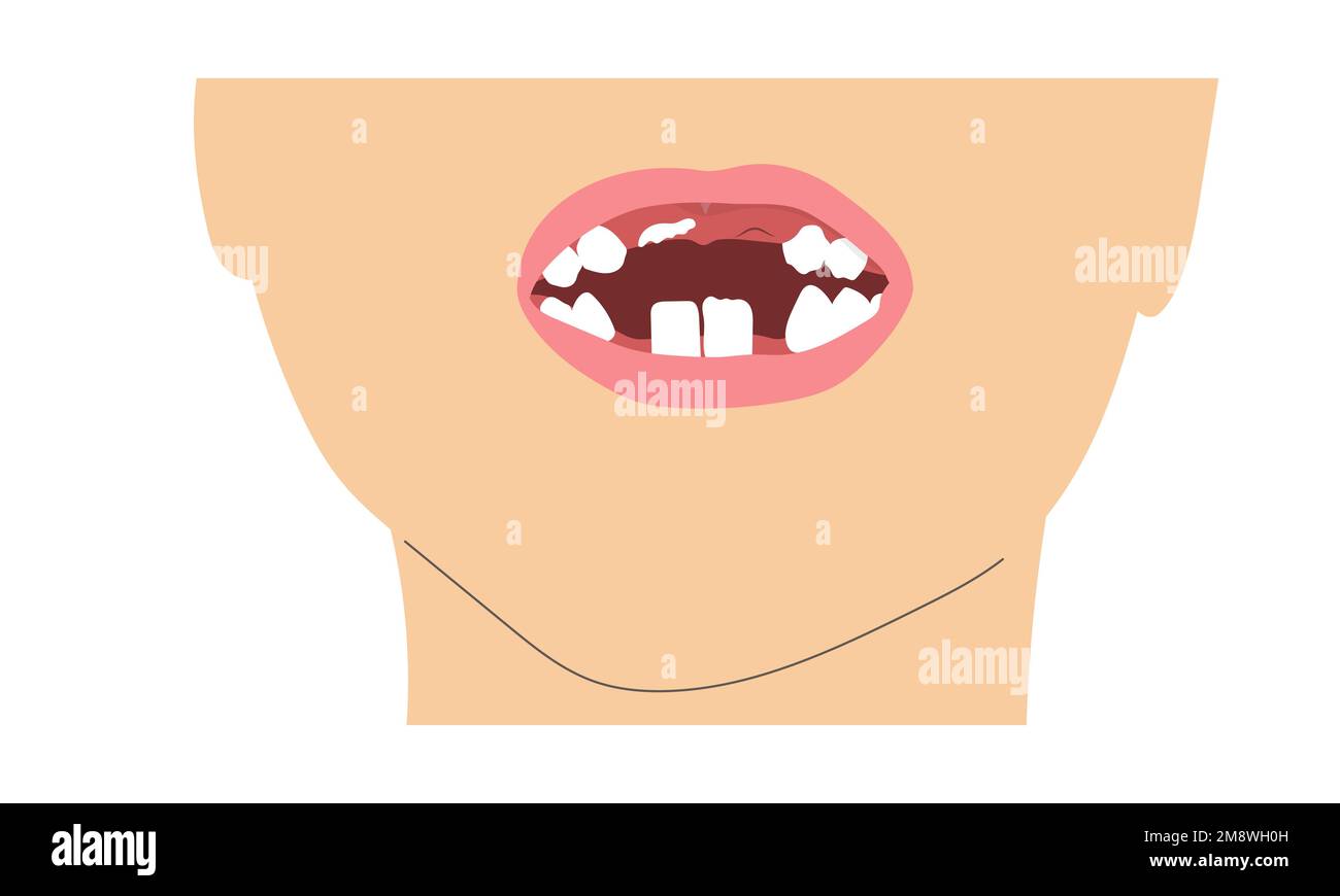 Un ragazzo sorride dente mancante a causa del cambio dei denti del latte. Semplice illustrazione minimalistica della bocca del bambino con un set di denti incompleto. Illustrazione Vettoriale