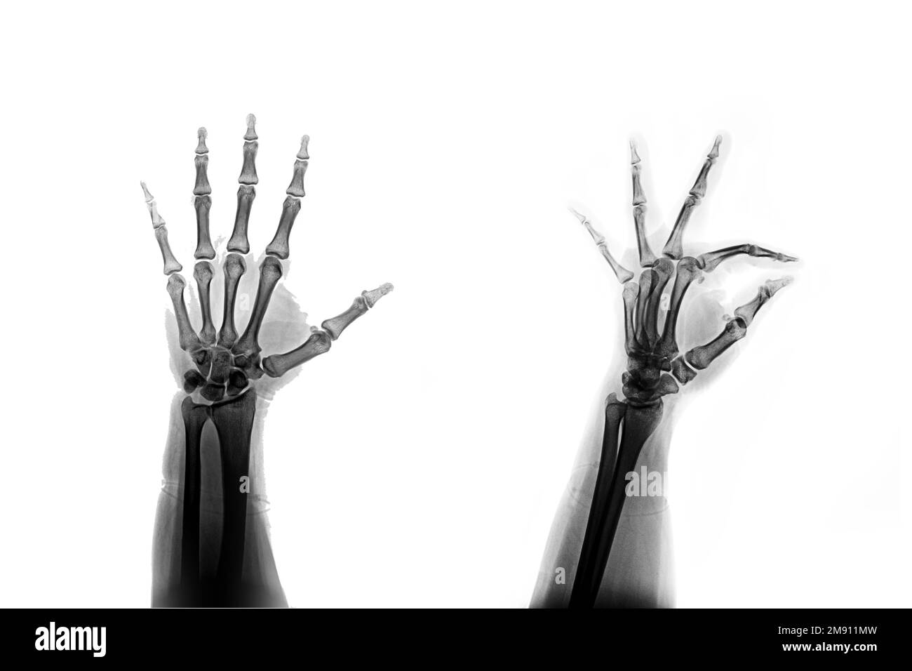 Posizione obliqua AP mano radiogena Foto Stock