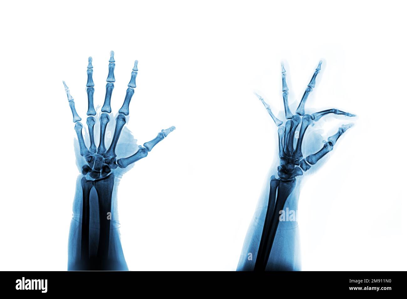 Posizione obliqua AP mano radiogena Foto Stock