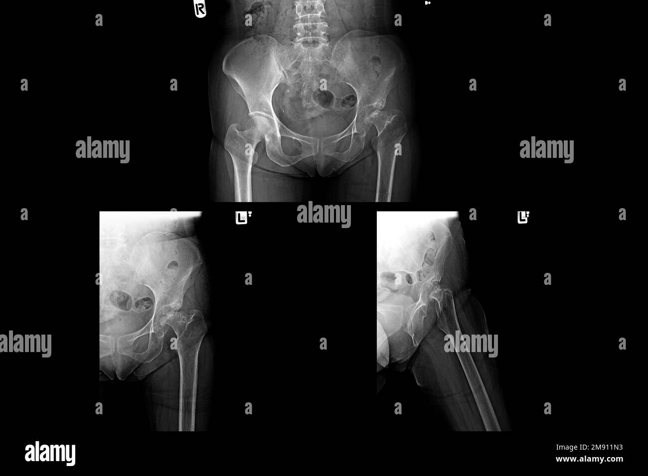 Radiografia su pellicola delle articolazioni pelviche e dell'anca umane Foto Stock