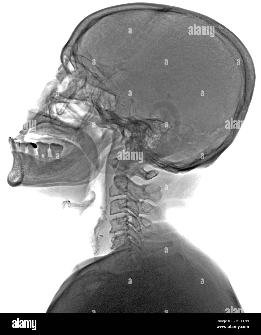 Radiografia vista laterale cranio Foto Stock