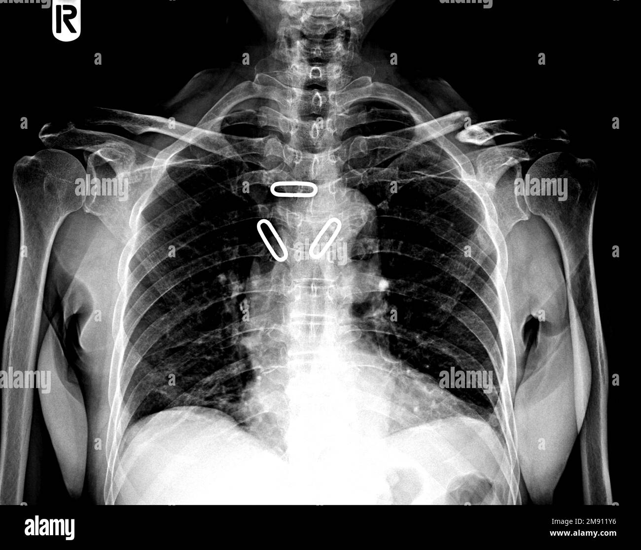 Figura della stecca di clavicola a 8 forme. Vista AP della clavicola radiologica Foto Stock