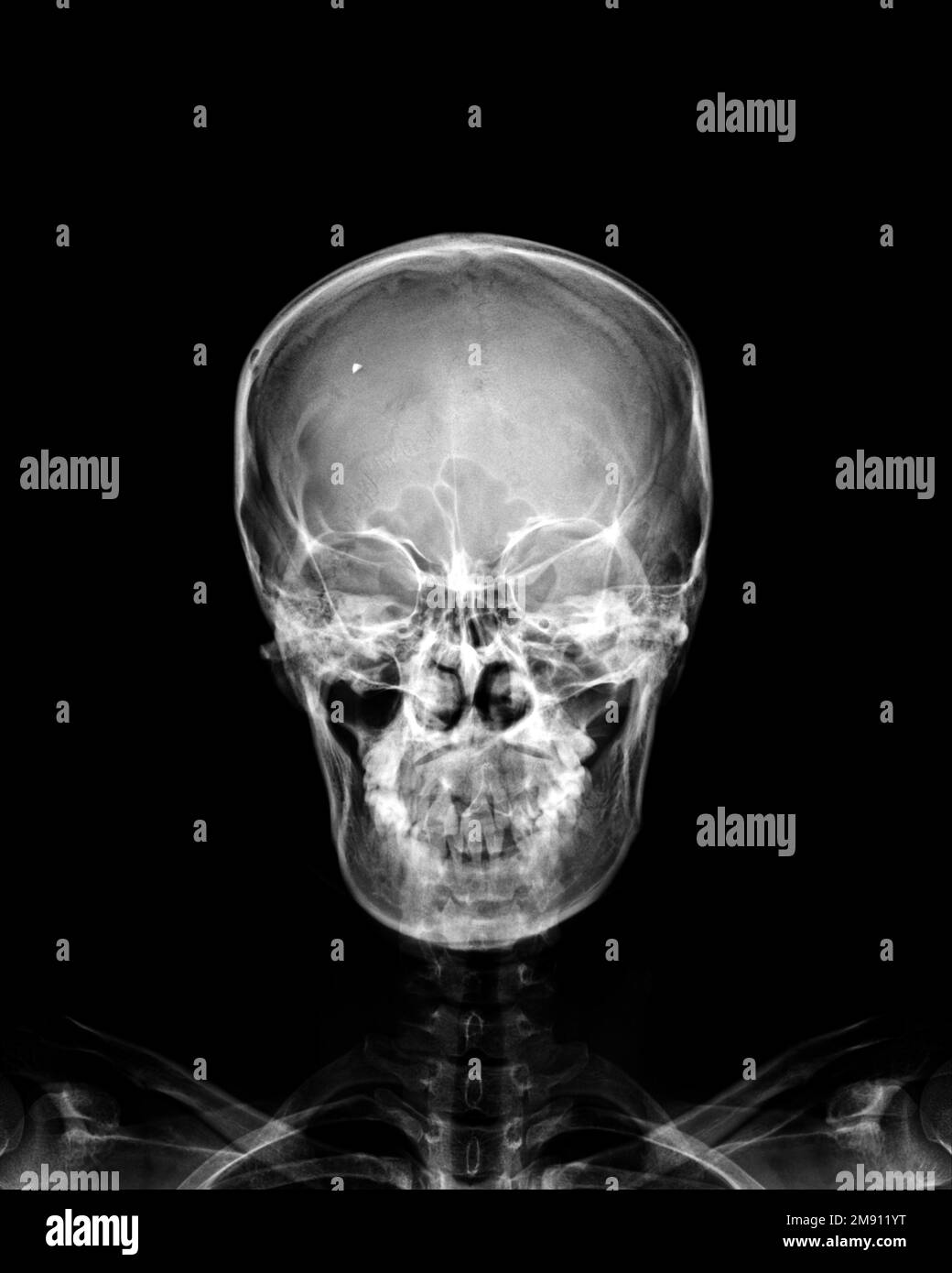 Filmare la radiografia del cranio umano normale su sfondo isolato Foto Stock