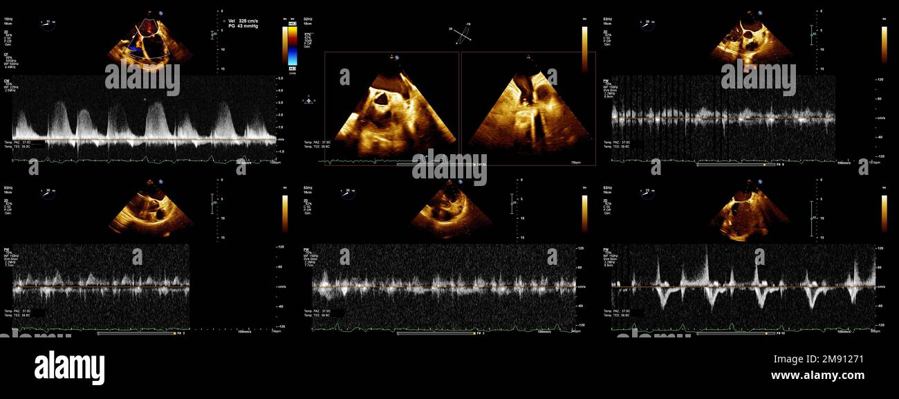 Banner o immagine del cuore durante l'ecografia transesofagea Foto Stock