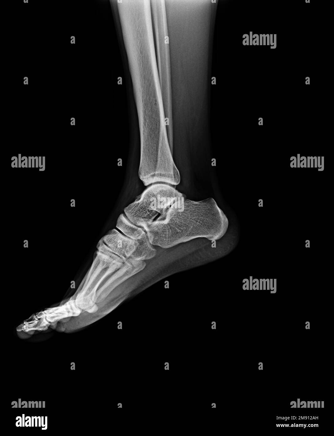 Raggi X piede umano normale . Vista laterale Foto Stock