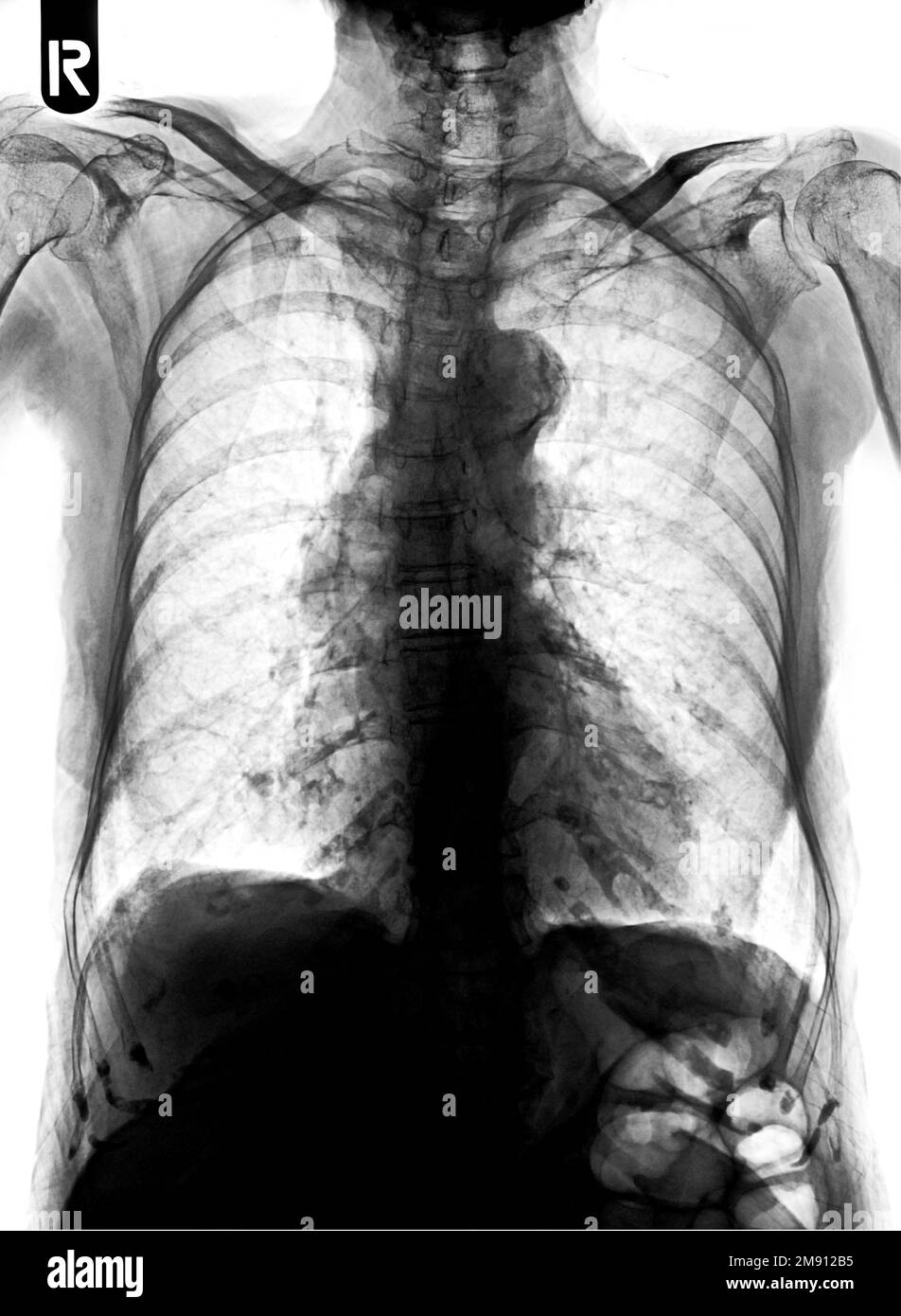 La radiografia toracica della pellicola mostra un'infiltrazione interstiziale di entrambi i polmoni Foto Stock